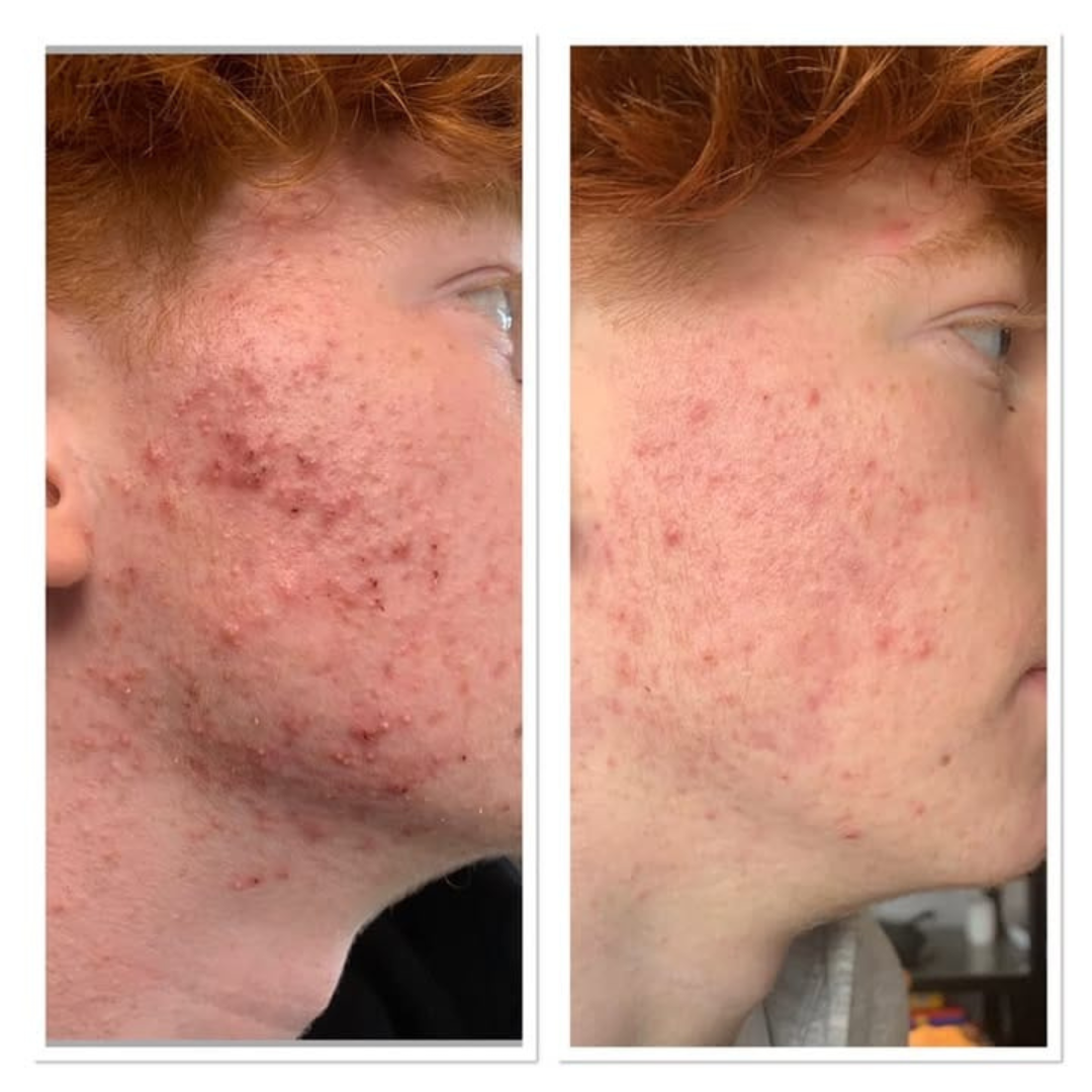 PRAVOLABS® – CLEAR SKIN FORMULA