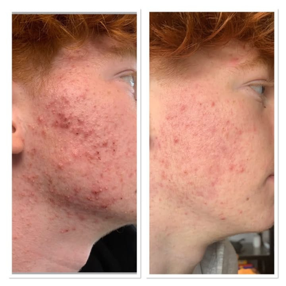 PRAVOLABS® – CLEAR SKIN FORMULA
