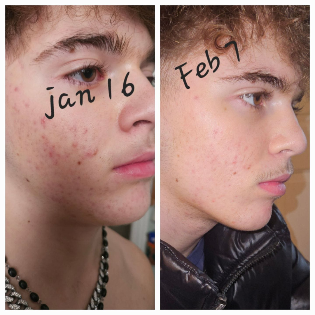 PRAVOLABS® – CLEAR SKIN FORMULA