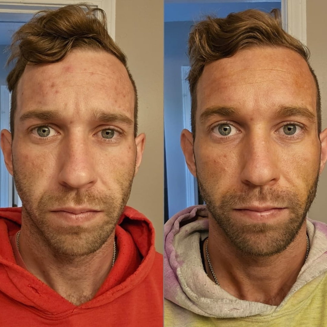 PRAVOLABS® – CLEAR SKIN FORMULA