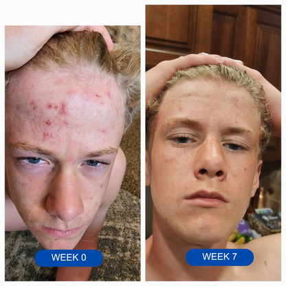PRAVOLABS® – CLEAR SKIN FORMULA